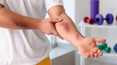 Sporty,Man,With,Bruises,On,Body,Training,In,Gym,,Closeup