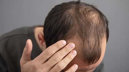 Mann hat Haarausfall Mann hat Haarausfall