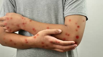 mpox, Affenpocken, Monkeypox Die Pocken einer Mpox-Infektion sind hochansteckend