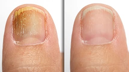 Zwei Zehen gegenübergestellt: Einer mit Nagelpilz und einer ohne Zwei Zehen gegenübergestellt: Einer mit Nagelpilz und einer ohne