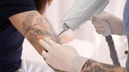 Per Laser lassen sich Tattoos am sichersten entfernen Per Laser lassen sich Tattoos am sichersten entfernen