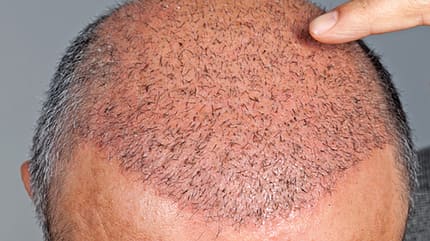 Bei Haarausfall entscheiden sich immer mehr Männer für eine Haartransplantation Bei Haarausfall entscheiden sich immer mehr Männer für eine Haartransplantation