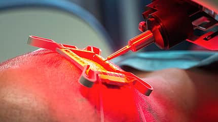 Der Haartransplantations-Roboter entnimmt Haarfollikel aus dem Hinterkopf Der Haartransplantations-Roboter entnimmt Haarfollikel aus dem Hinterkopf