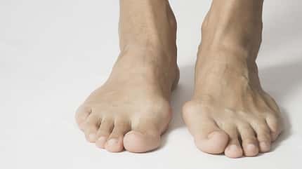 Ein verformter Großzehknochen (Hallux valgus) kann Fußschmerzen auslösen Ein verformter Großzehknochen (Hallux valgus) kann Fußschmerzen auslösen
