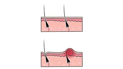 Eine der häufigsten Folgen der Rasur sind eingewachsene Haare, die zu Entzündungen führen Eine der häufigsten Folgen der Rasur sind eingewachsene Haare, die zu Entzündungen führen
