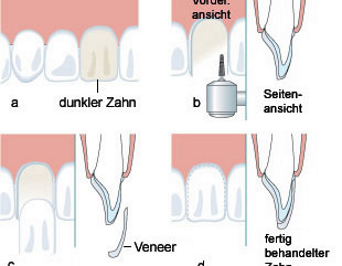 0405_H_Zeigt_eure_Zähne_grafik_veneers_310 0405_H_Zeigt_eure_Zähne_grafik_veneers_310