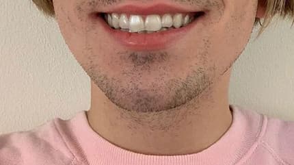 So sieht die unsichtbare Zahnspange aus So sieht die unsichtbare Zahnspange aus