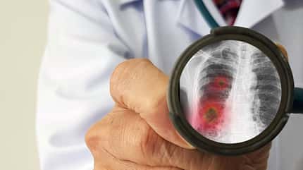 Erst ein Röntgenbild bringt bei Lungenkrankheiten eine sichere Diagnose.