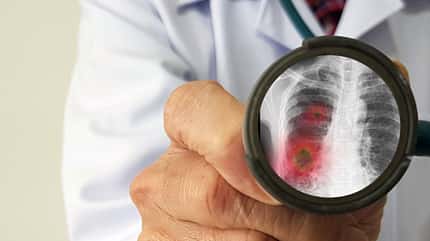 Coronaviurs, Lungenentzündung Das Coronavirus kann gefährliche Lungenentzündungen auslösen