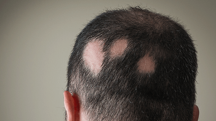 Beim kreisrunden Haarausfall entstehen münzgroße Lücken Beim kreisrunden Haarausfall entstehen münzgroße Lücken