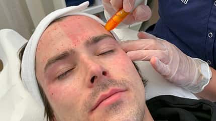 Mesotherapie im Test Mesotherapie im Test