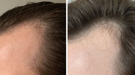 PRP für die Haare: Vorher-Nachher-Vergleich PRP für die Haare: Vorher-Nachher-Vergleich