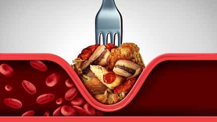 Fettige Lebensmittel fördern Cholesterin-Ablagerungen in den Arterien, es entstehen Engstellen, die zu Herzinfarkten führen können.