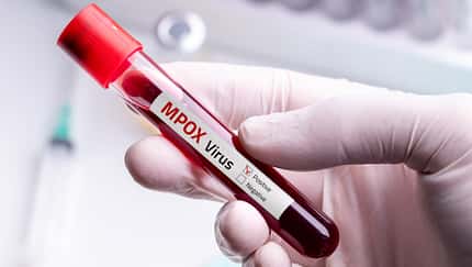 Mpox ist die Abkürzung für Monkeypox, auf Deutsch Affenpocken