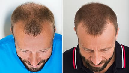 2800 Haarfollikel wurden Oliver bei einer Haartransplantation verpflanzt