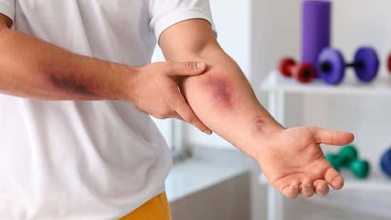 Sporty,Man,With,Bruises,On,Body,Training,In,Gym,,Closeup