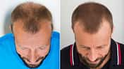2800 Haarfollikel wurden Oliver bei einer Haartransplantation verpflanzt