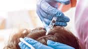 So hilft Blut gegen Haarausfall