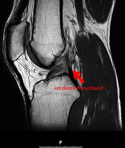 Das Kreuzband stabilisiert das Knie und hält es zusammen Das Kreuzband stabilisiert das Knie und hält es zusammen